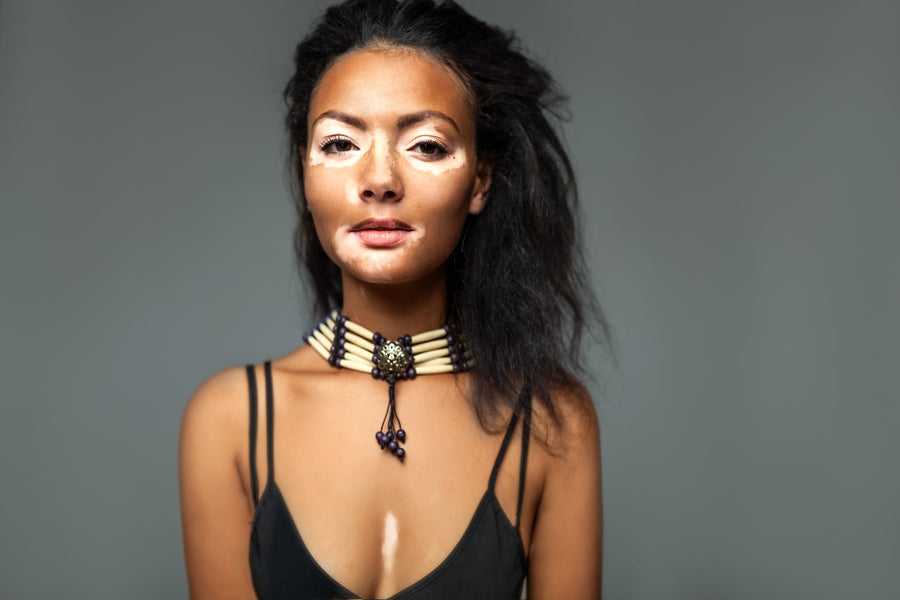 History of Vitiligo treatment