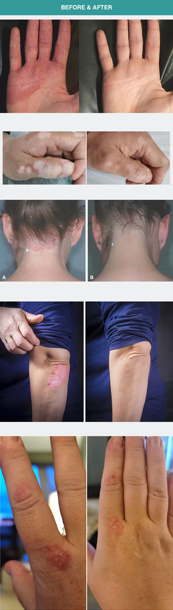 Before and after UVB Phototherapy treatment